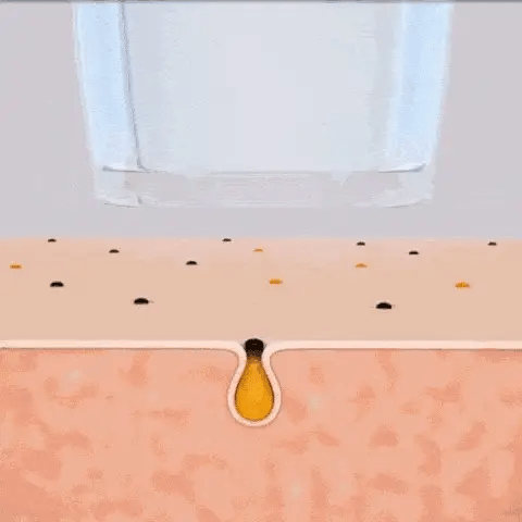 Blackhead Remover med kamera