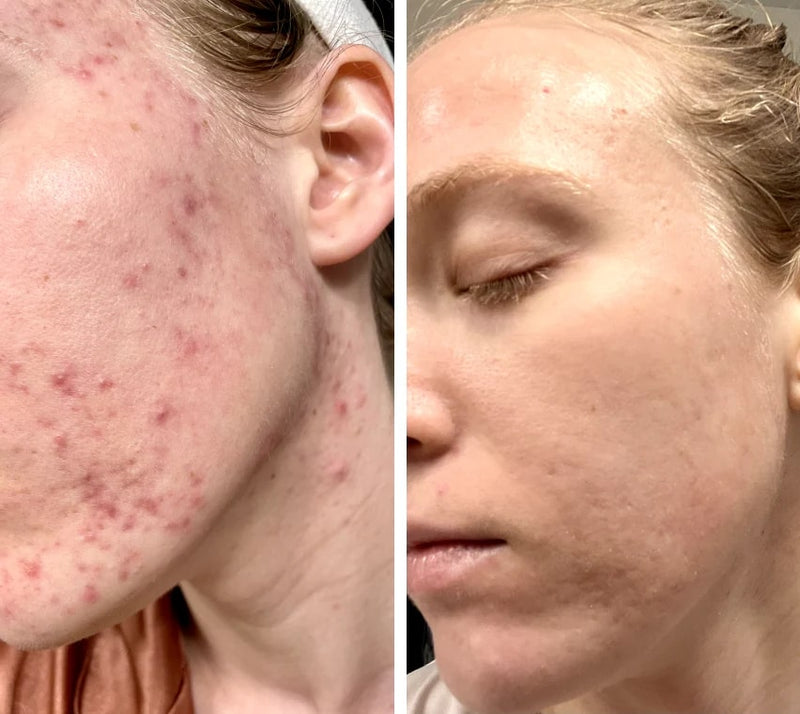 LED Ljusterapi Mask LUMIDARK