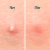 Pimple Patches