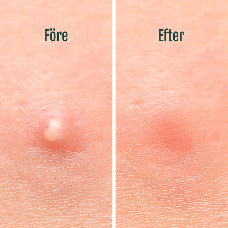 Silky Planet Anti-Pickel Plåster för dag- och nattbruk – fungerar 24/7