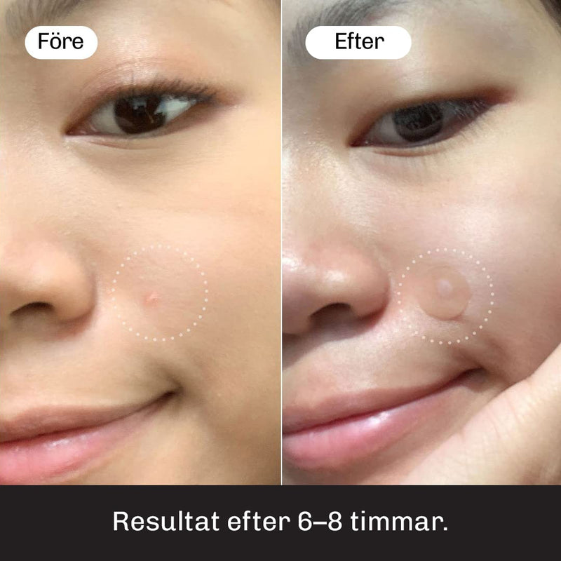 Hydrokolloidteknik hos Silky Planet Anti-Pickel Plåster – absorberar vätska och skyddar huden