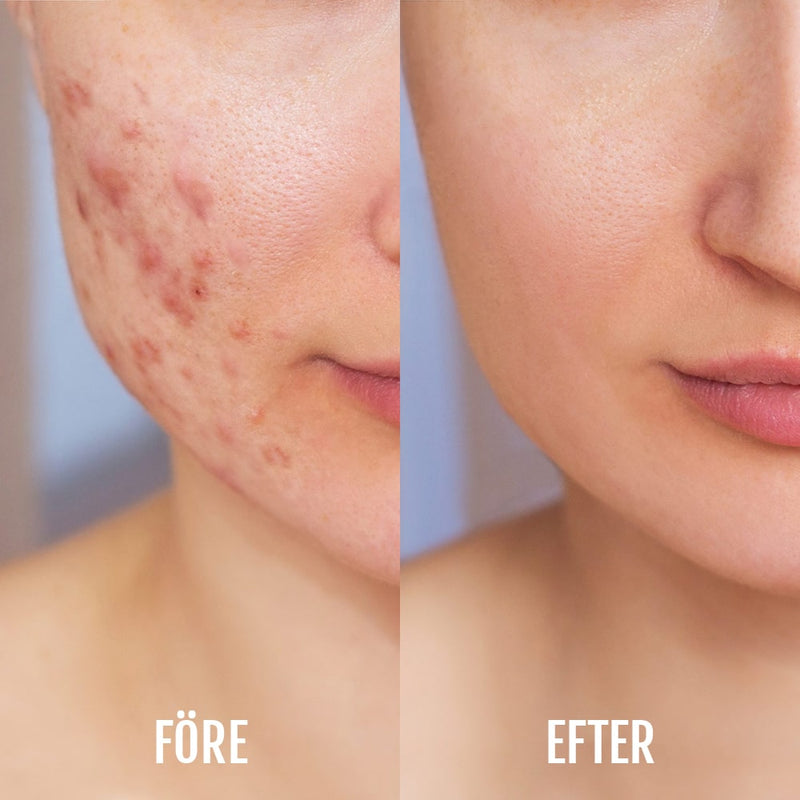 Rött LED-ljus kan lugna irritation och främja hudens regenerering