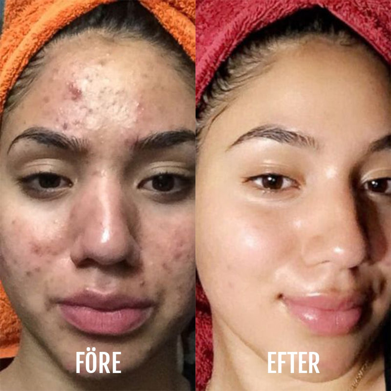 Användning i ansiktet – DermaClear fungerar punktvis eller på större hudområden