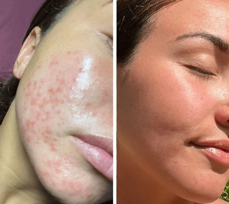 Ergonomisk passform för komfort under hela behandlingen