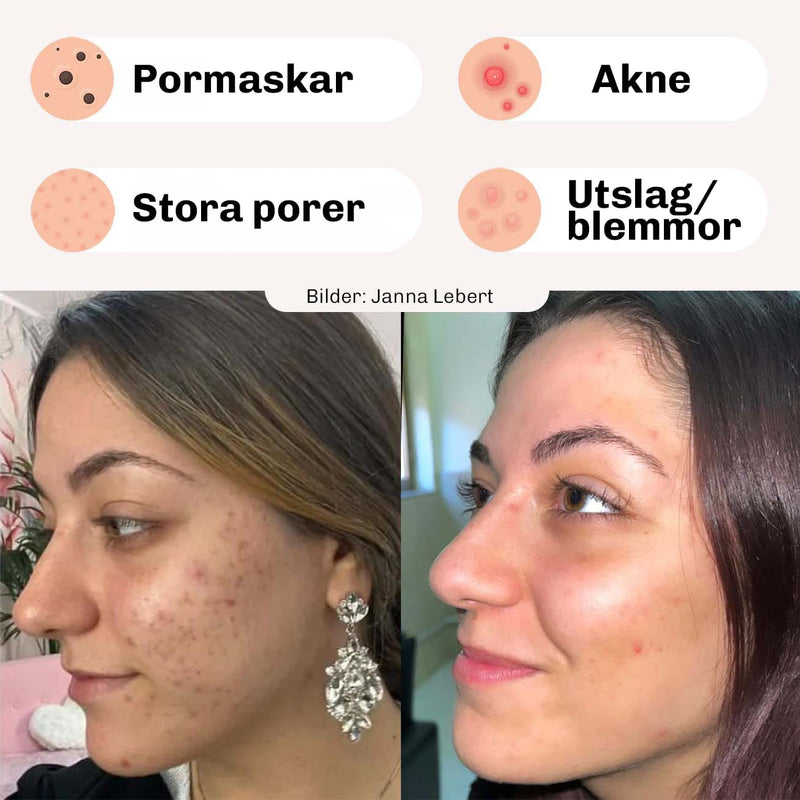 Före-efter jämförelse med Silky Planet Mitesser Home Creme – synligt klarare hud